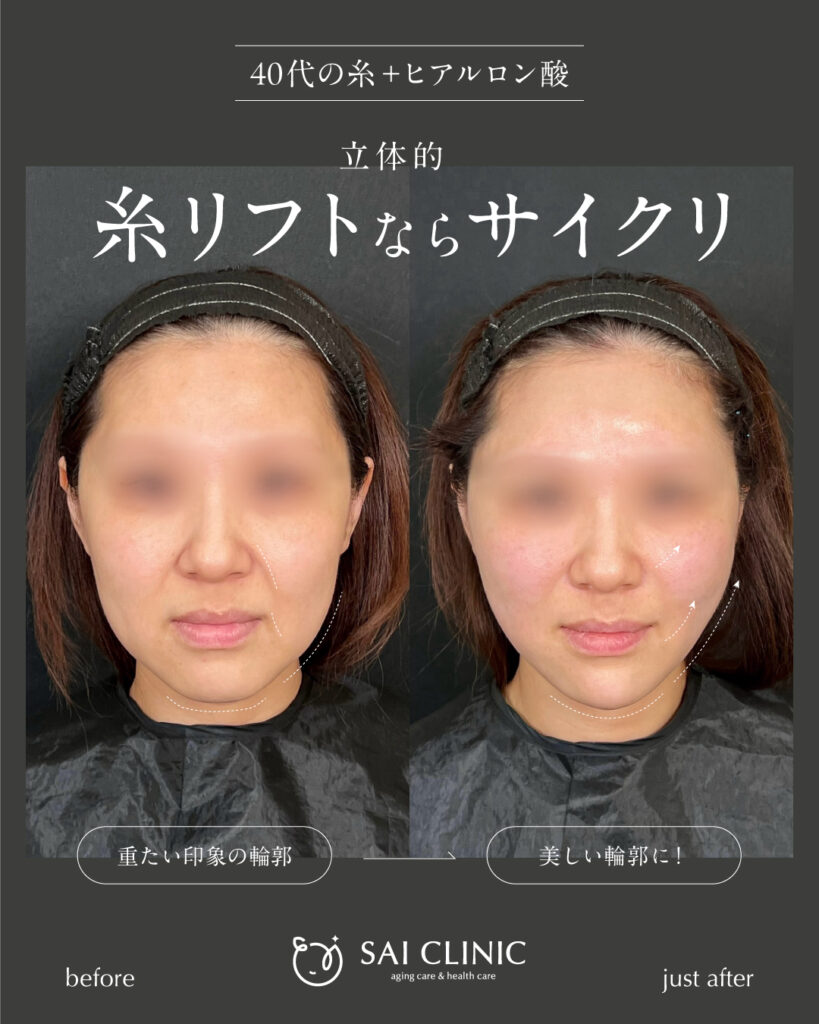 40代女性｜糸リフト＋ヒアルロン酸