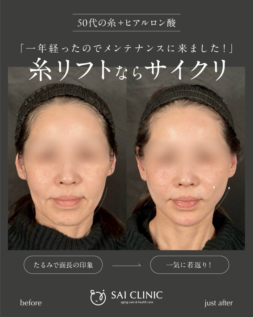 50代女性｜糸リフト＋ヒアルロン酸