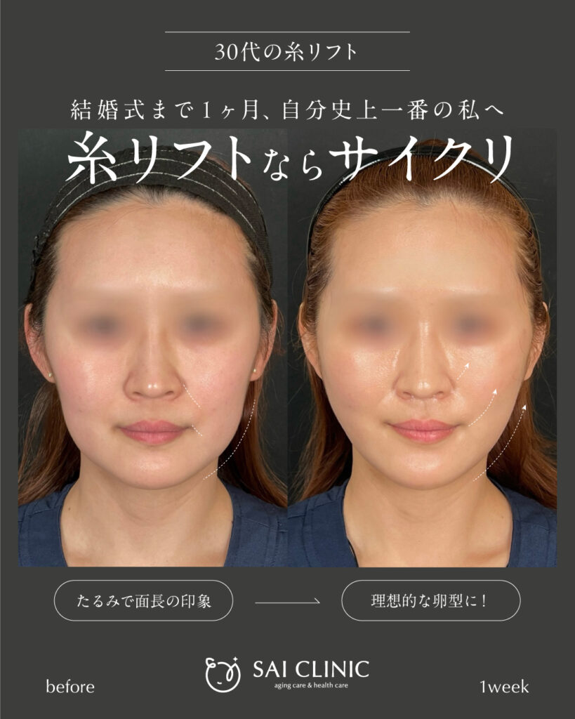 30代女性｜糸リフト