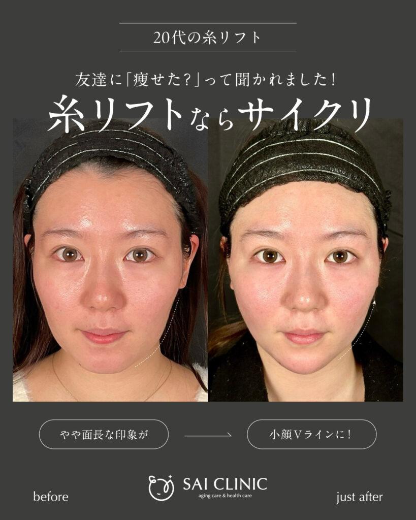 20代女性|糸リフト
