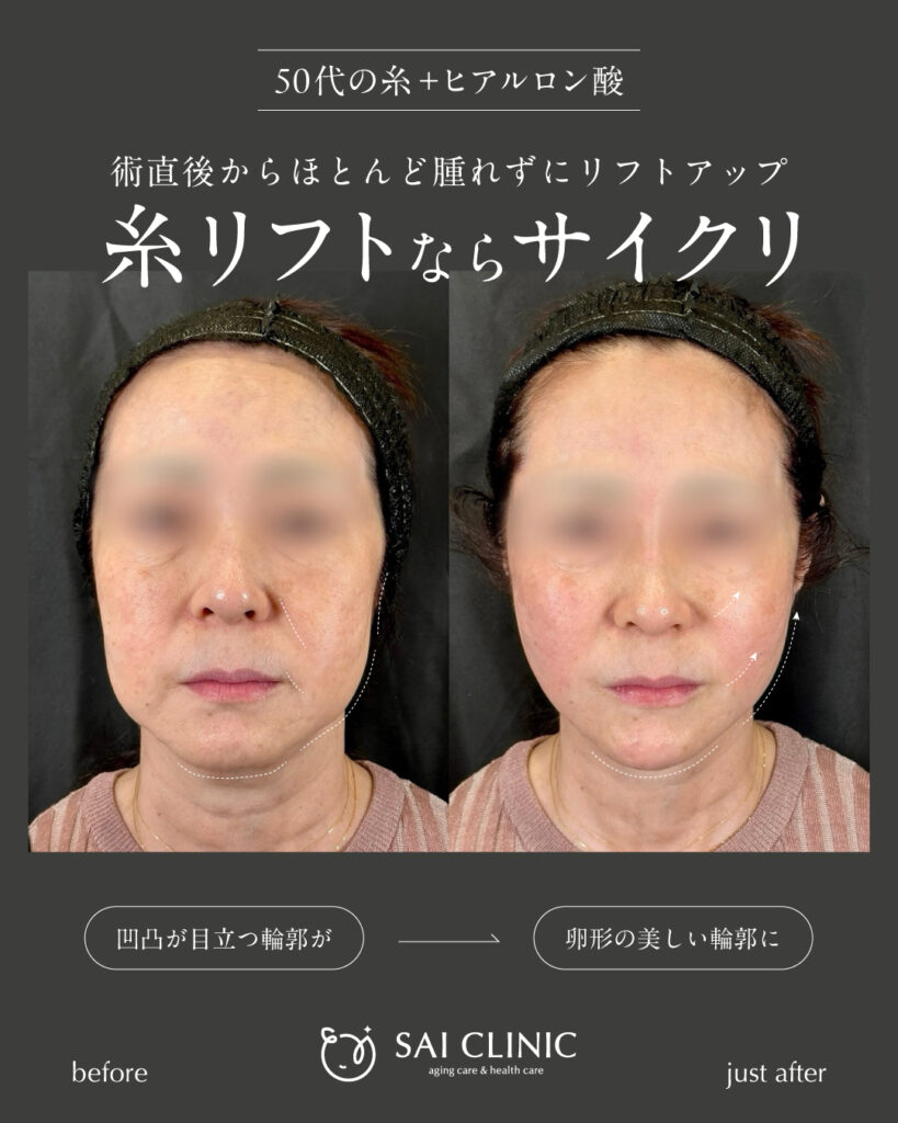 50代女性|糸リフト+ヒアルロン酸