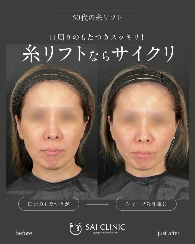 50代女性|糸リフト