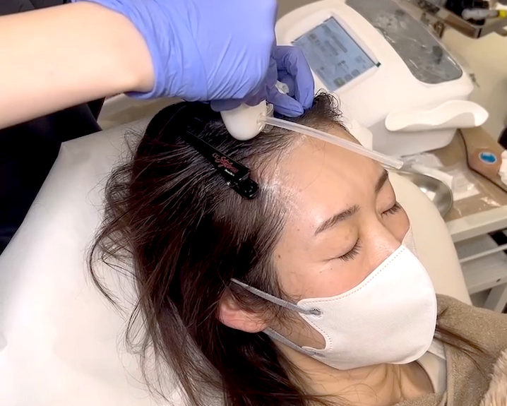 薄毛治療 ハイコックス