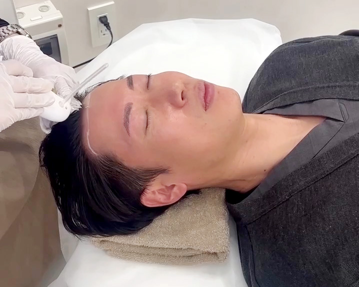 薄毛治療 ハイコックス