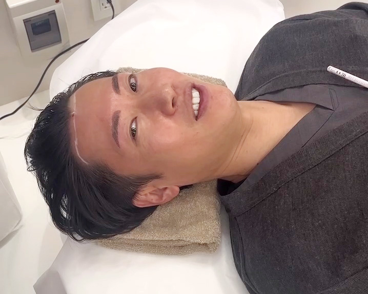 薄毛治療 ハイコックス