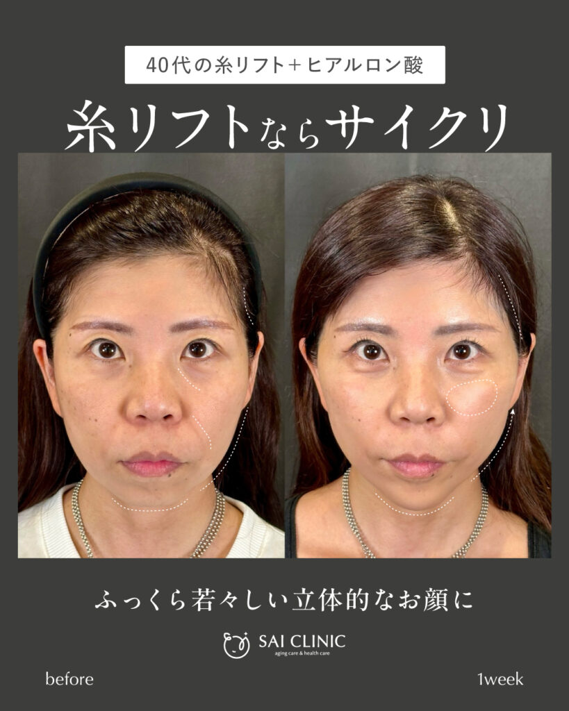 40代女性 糸リフト+ヒアルロン酸