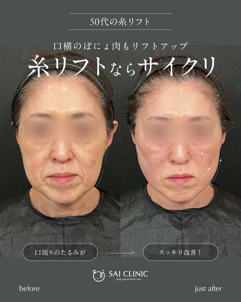 50代女性 糸リフト