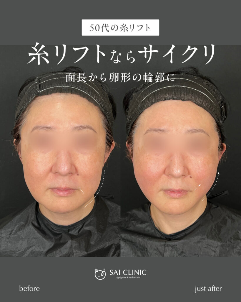 50代女性 糸リフト