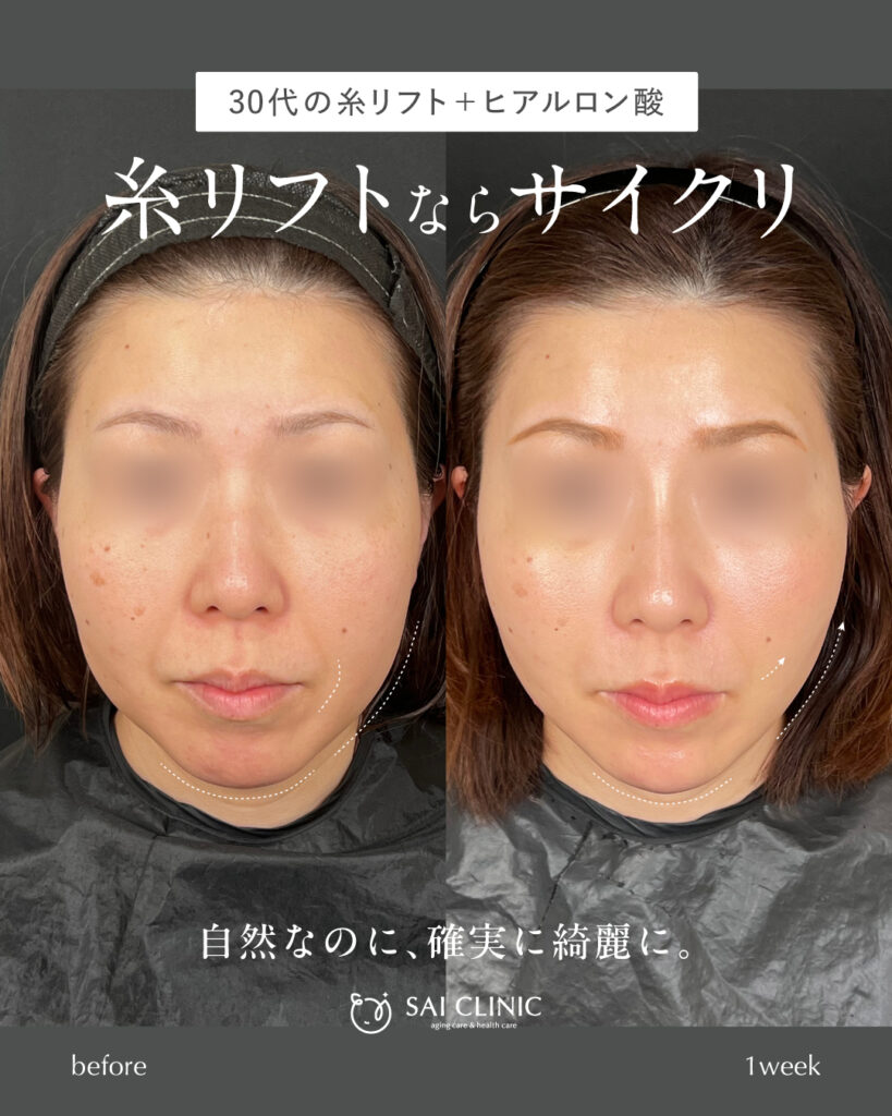 30代女性 糸リフト+ヒアルロン酸