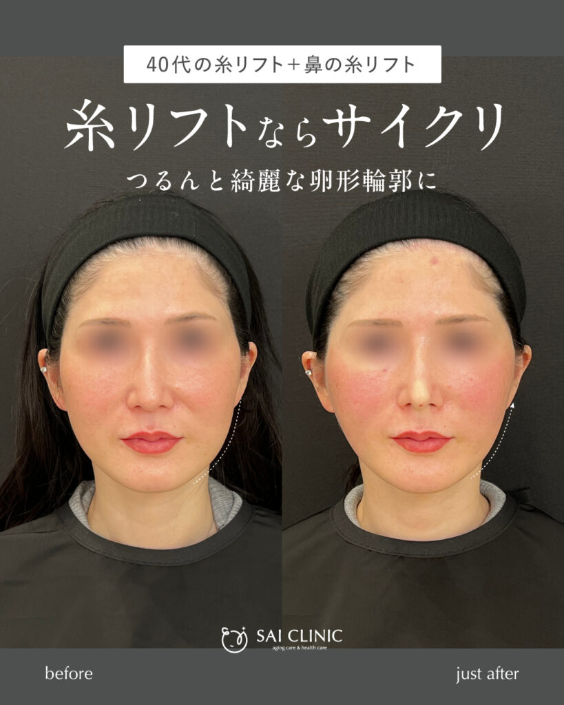 40代女性 糸リフト+鼻の糸リフト