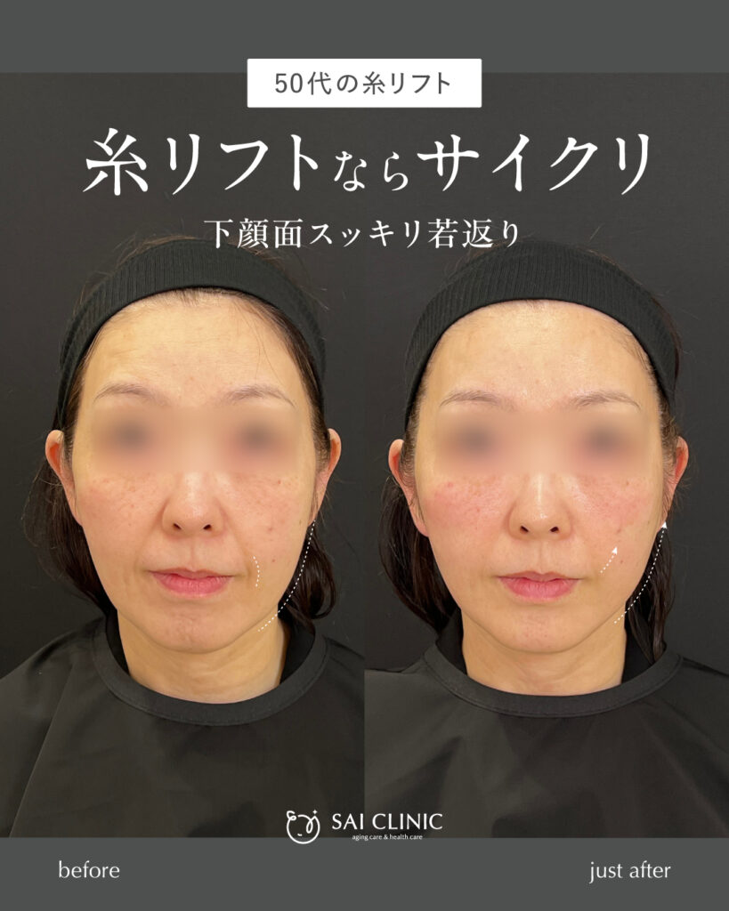 50代女性 糸リフト(14本)
