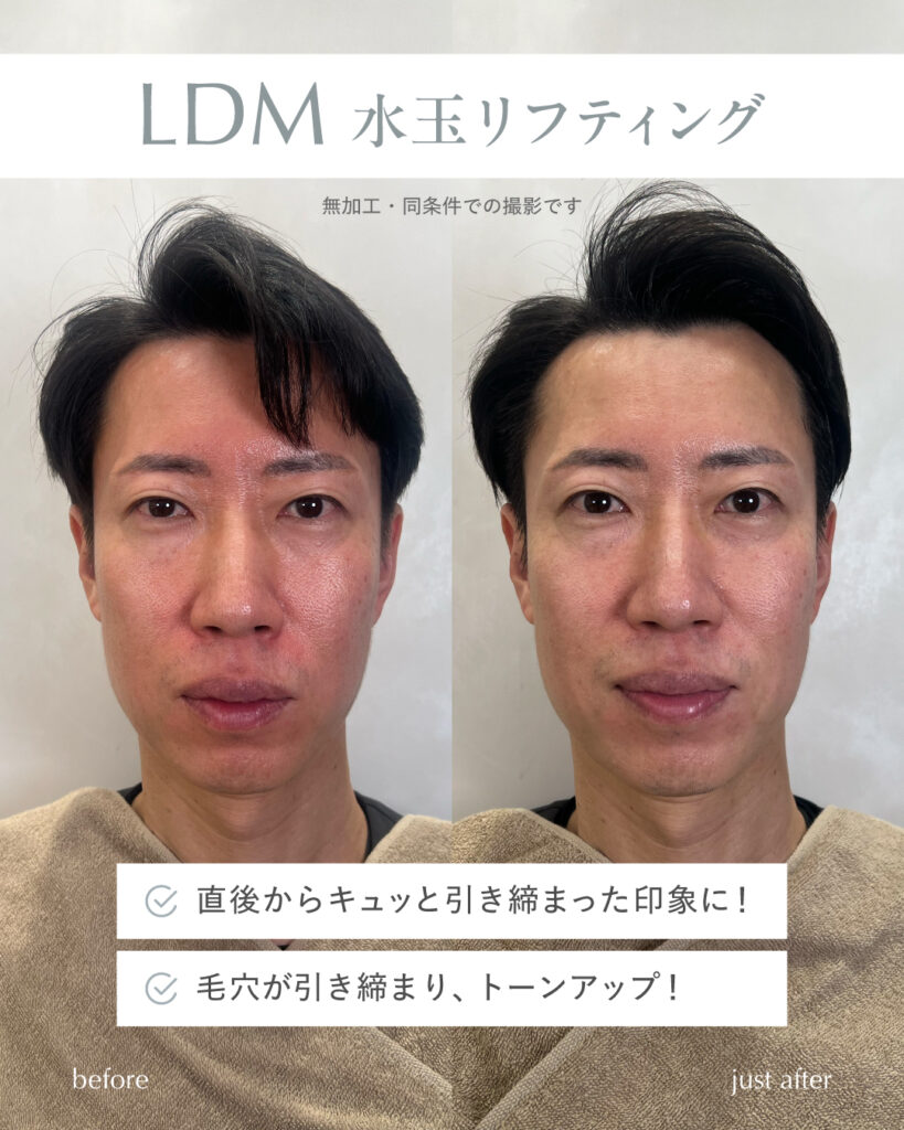 LDM 水玉リフティングをサイ院長が受けてみました!