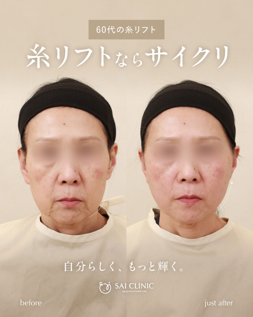 60代女性 糸リフト