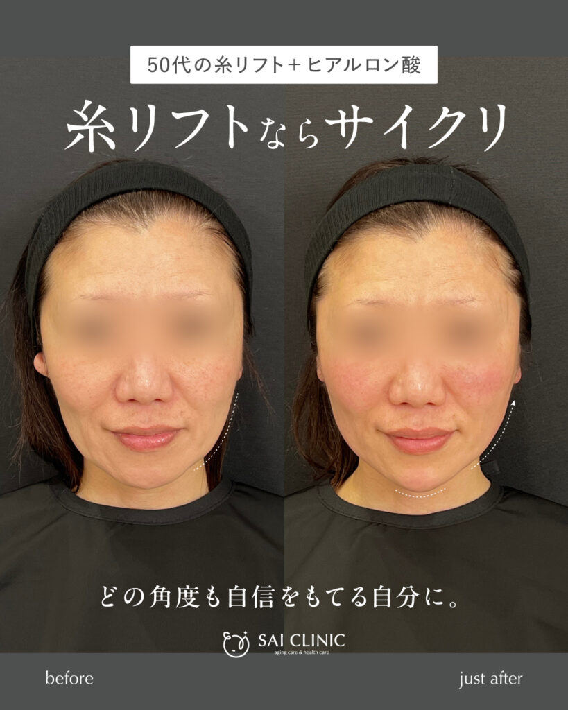 50代女性 糸リフト+ヒアルロン酸