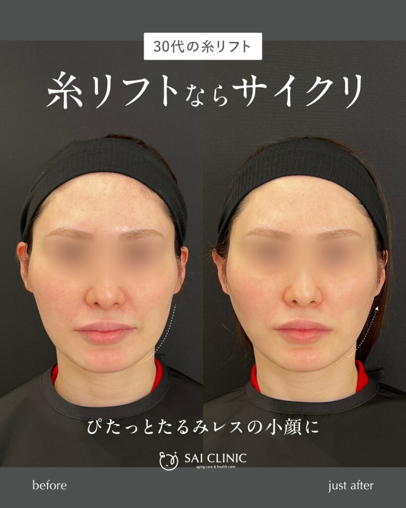 30代女性 糸リフト