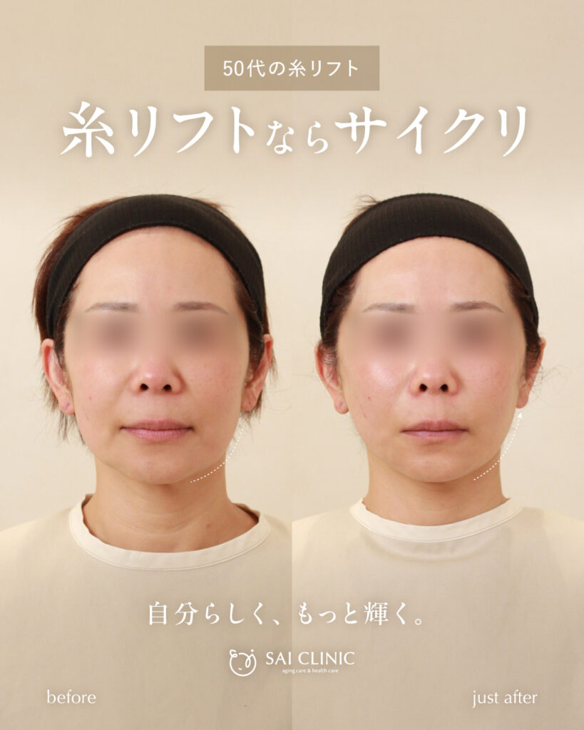 50代女性 糸リフト