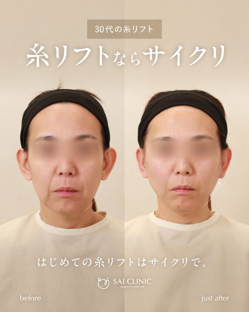 30代女性 糸リフト