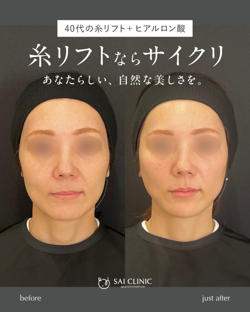 【40代女性】糸リフト+ヒアルロン酸
