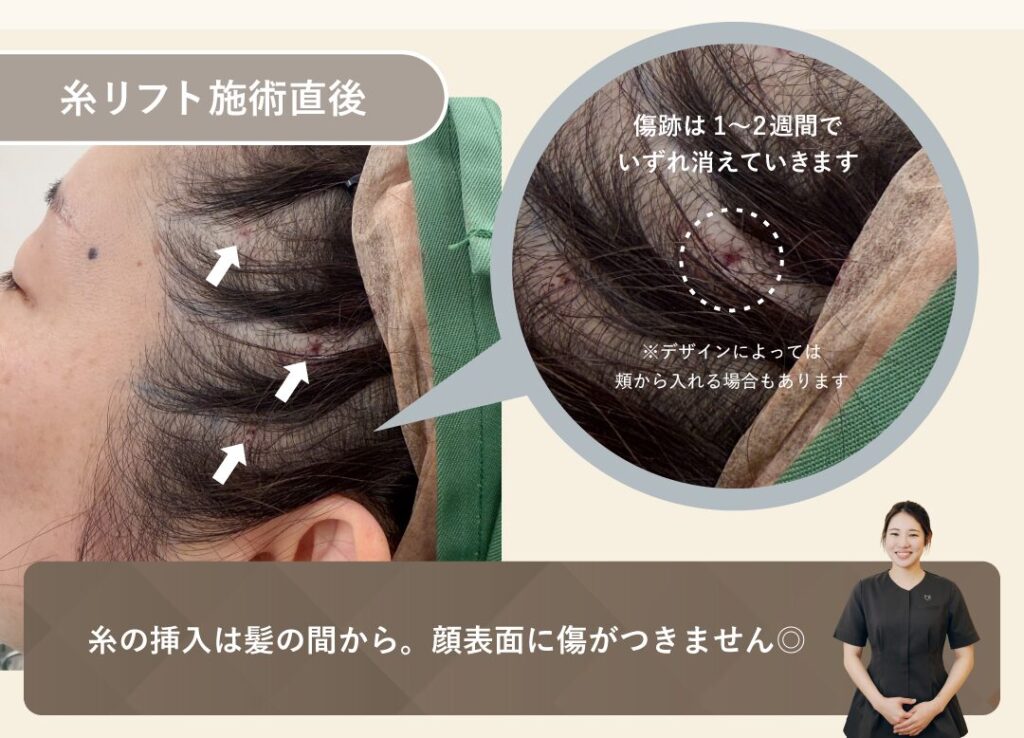 サイ院長の糸リフトは、髪の毛の間から刺入するのでダウンタイムが目立ちません。