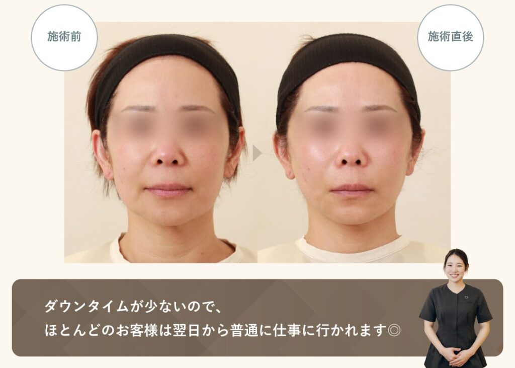 直後からダウンタイム最小限なので、翌日からお仕事でも大丈夫です。