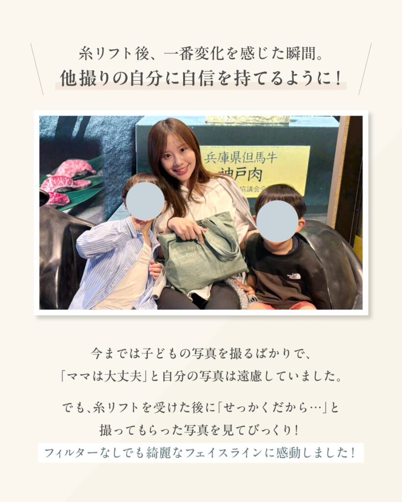 糸リフトで他撮りの自分に自信が！