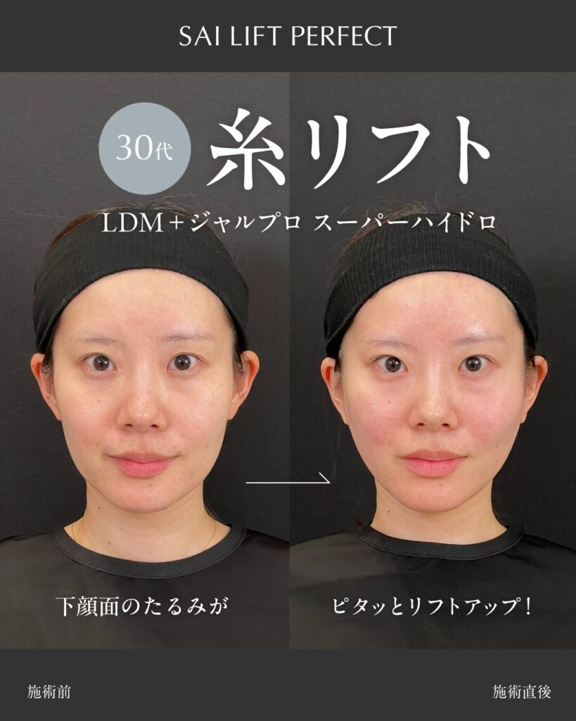 37歳女性 糸リフト