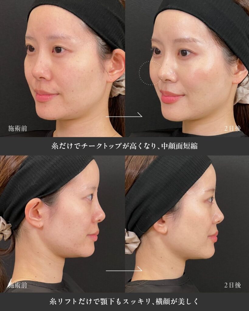 糸リフトだけでこんなに綺麗に！