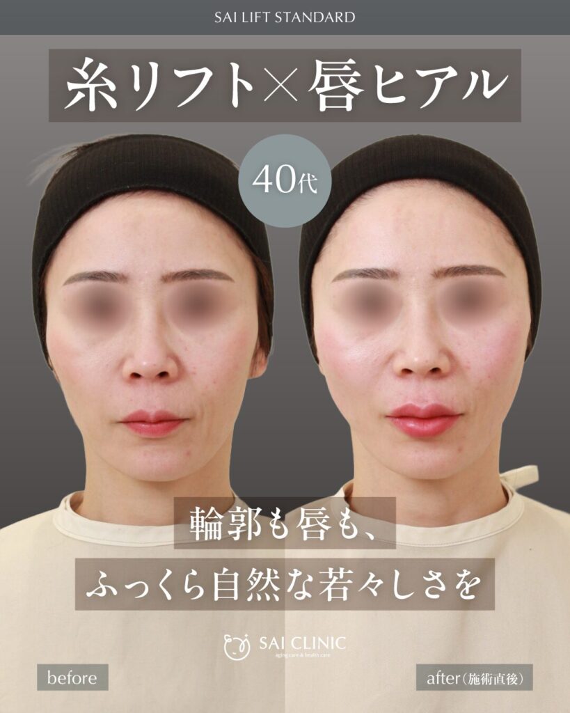 【40代女性】糸リフト＋唇ヒアルロン酸の症例写真