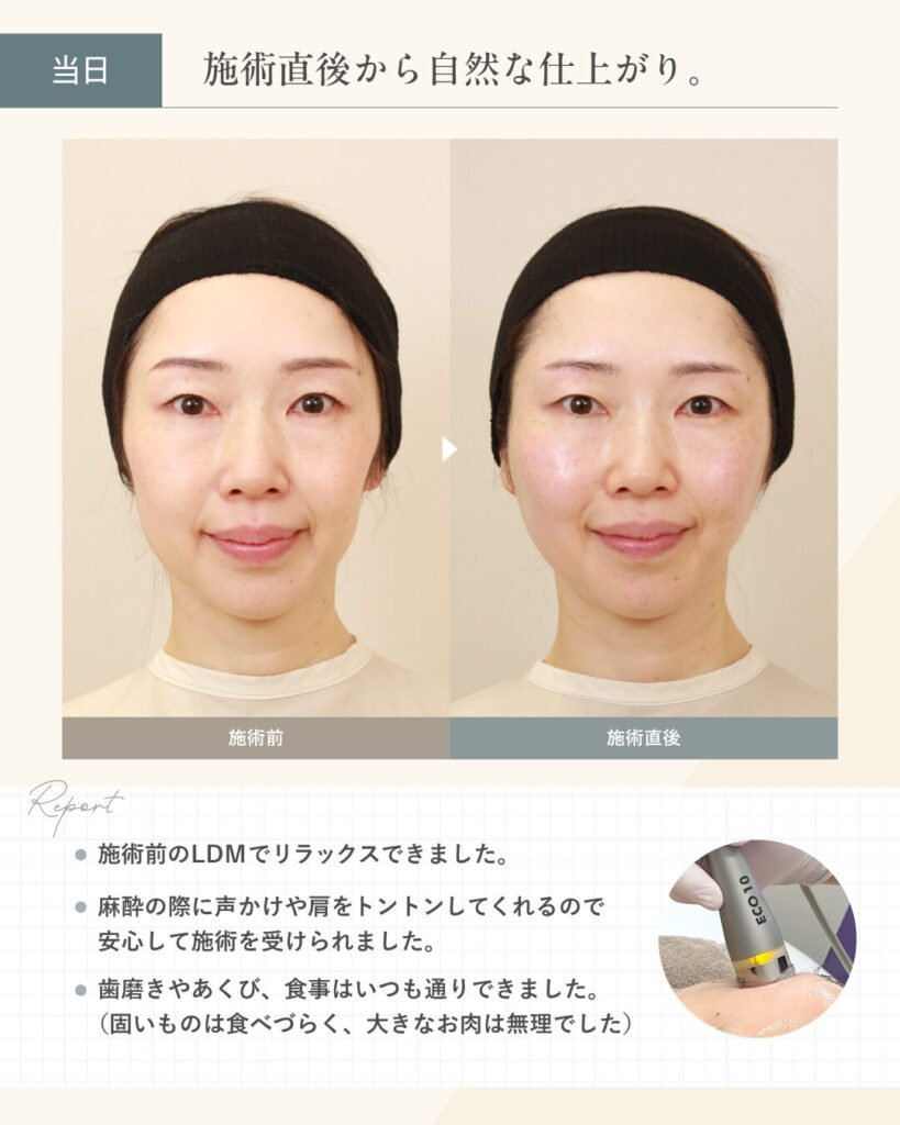 【糸リフト施術当日】施術直後から自然な仕上がり