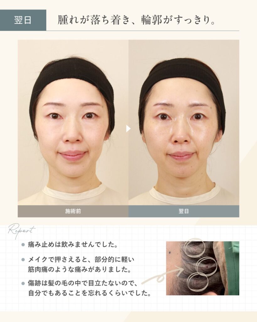 【糸リフト施術翌日】腫れが落ち着き、輪郭がすっきりしました。