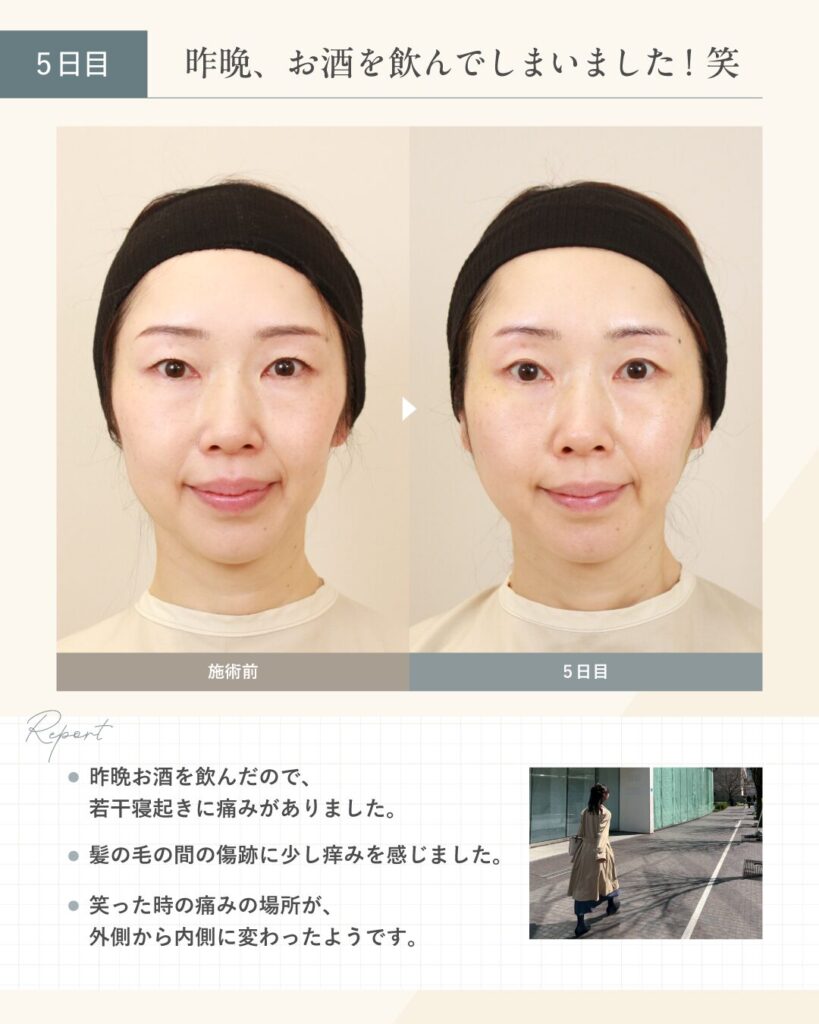 【糸リフト施術5日目】昨晩はお酒を飲んでしまいました！笑