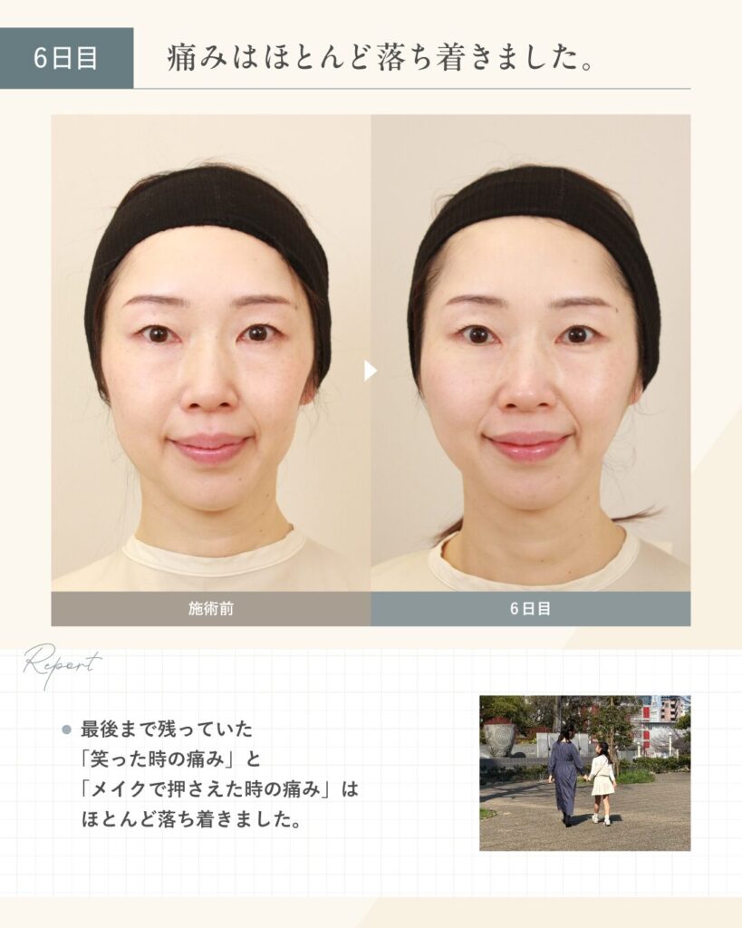 【糸リフト施術6日目】痛みはほとんど落ち着きました。