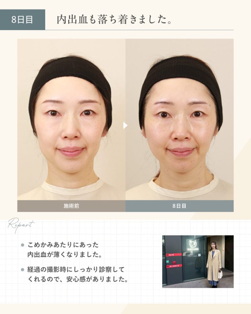 【糸リフト施術8日目】内出血も落ち着きました。