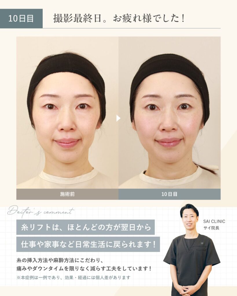 【糸リフト施術10日目】ダウンタイムが落ち着き、若々しい輪郭に。