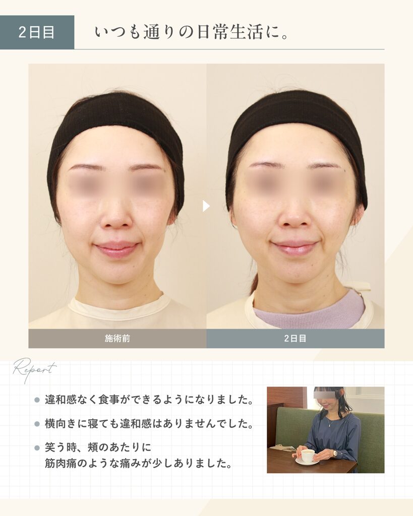 【40代女性】糸リフトのダウンタイム 2日目