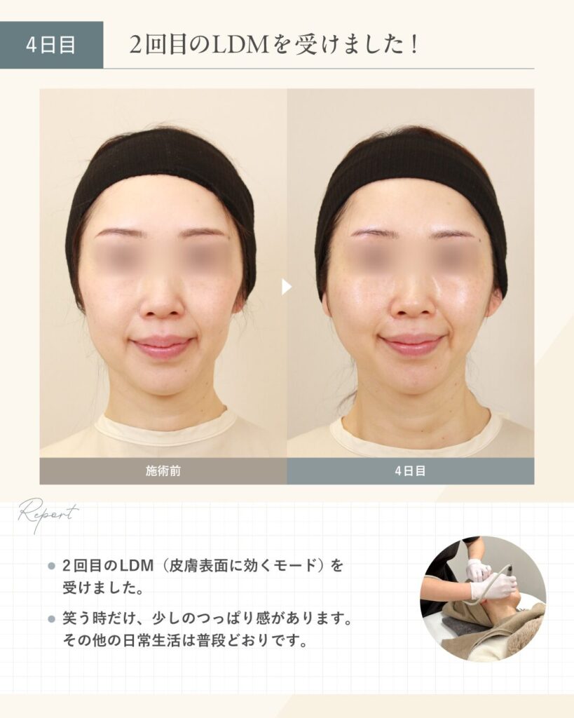 【40代女性】糸リフトのダウンタイム 4日目