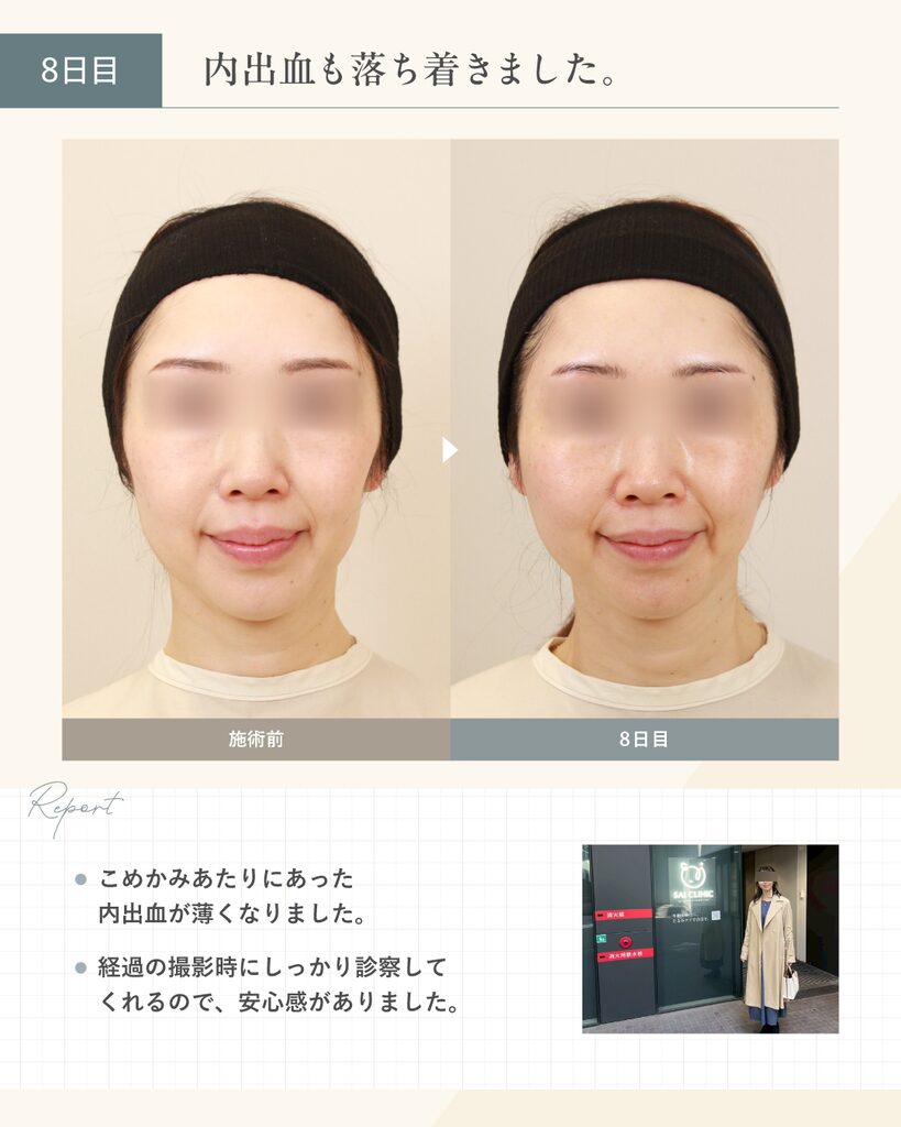 【40代女性】糸リフトのダウンタイム 8日目