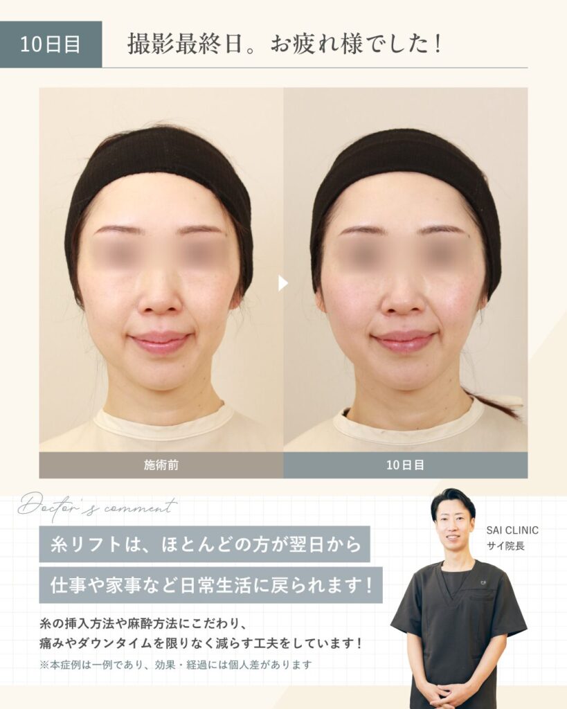【40代女性】糸リフトのダウンタイム 10日目