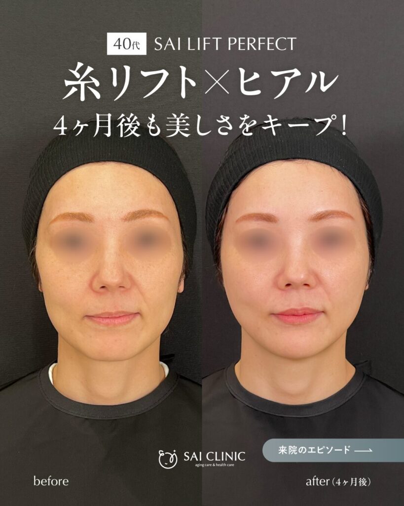 【40代女性】糸リフト×ヒアルロン酸