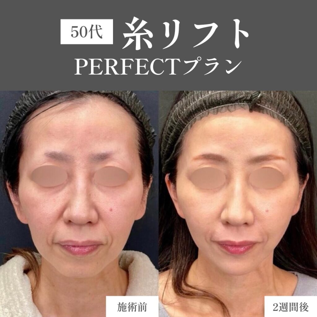 50代女性 糸リフト