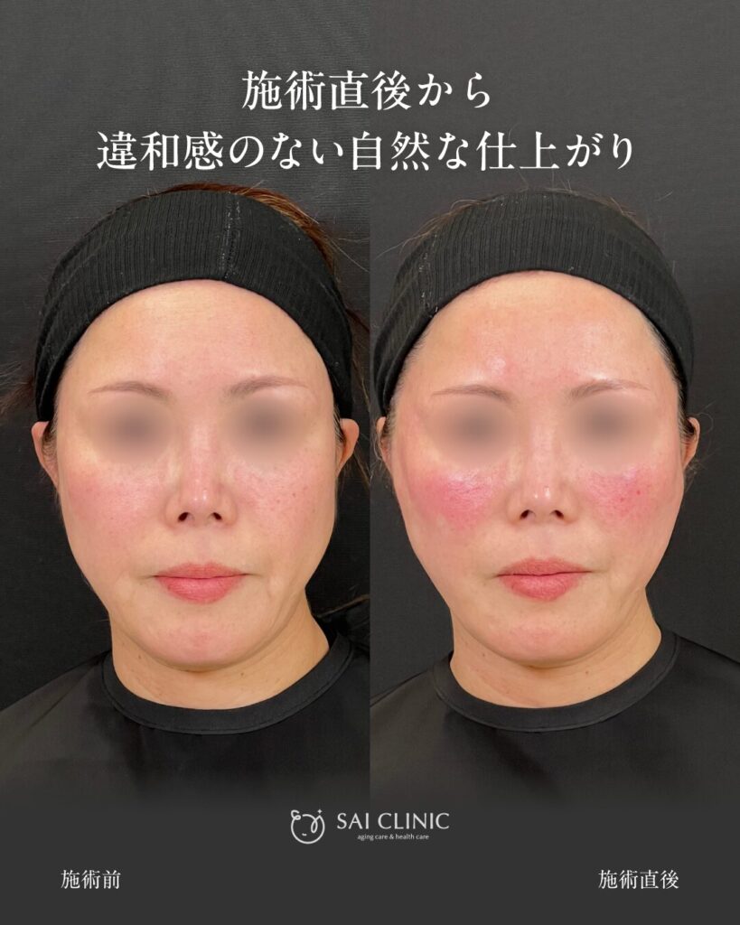 【50代女性】糸リフト×ヒアルロン酸