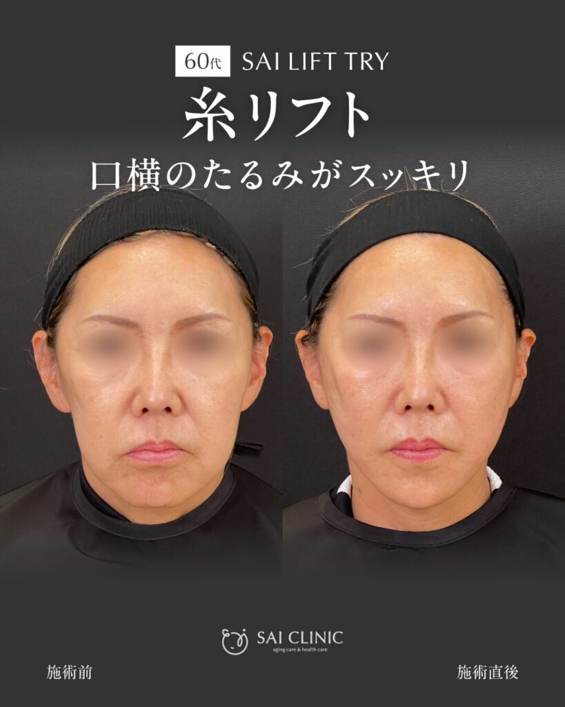 60代女性 糸リフト
