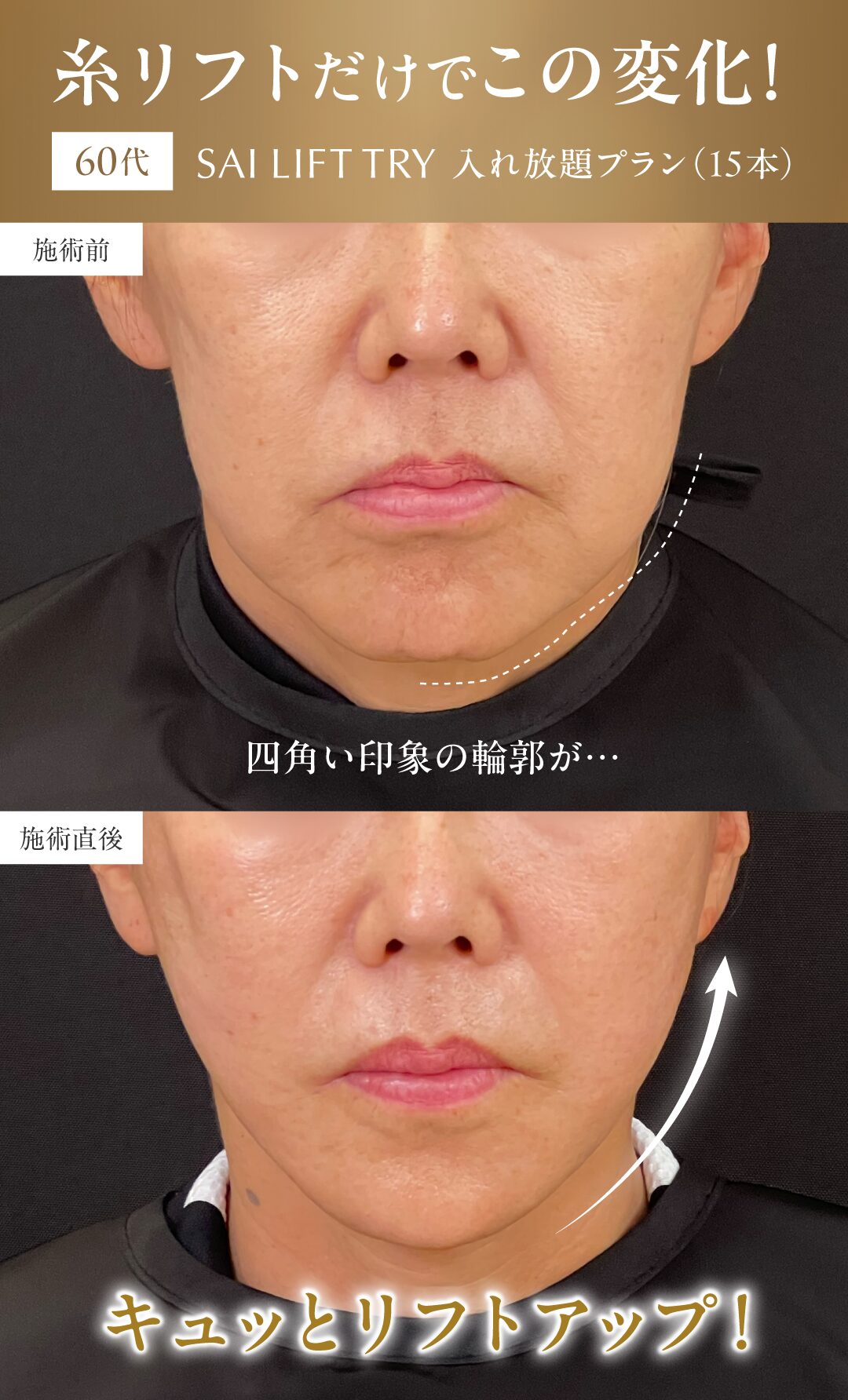 糸リフトだけでこの変化！60代モニター様
