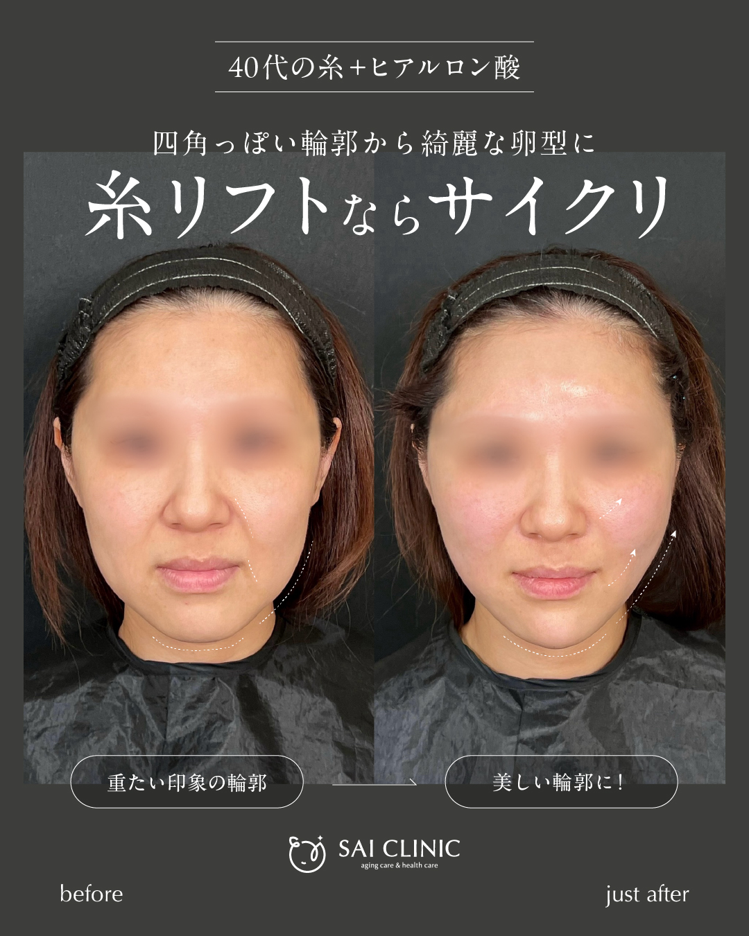 40代女性 糸リフト