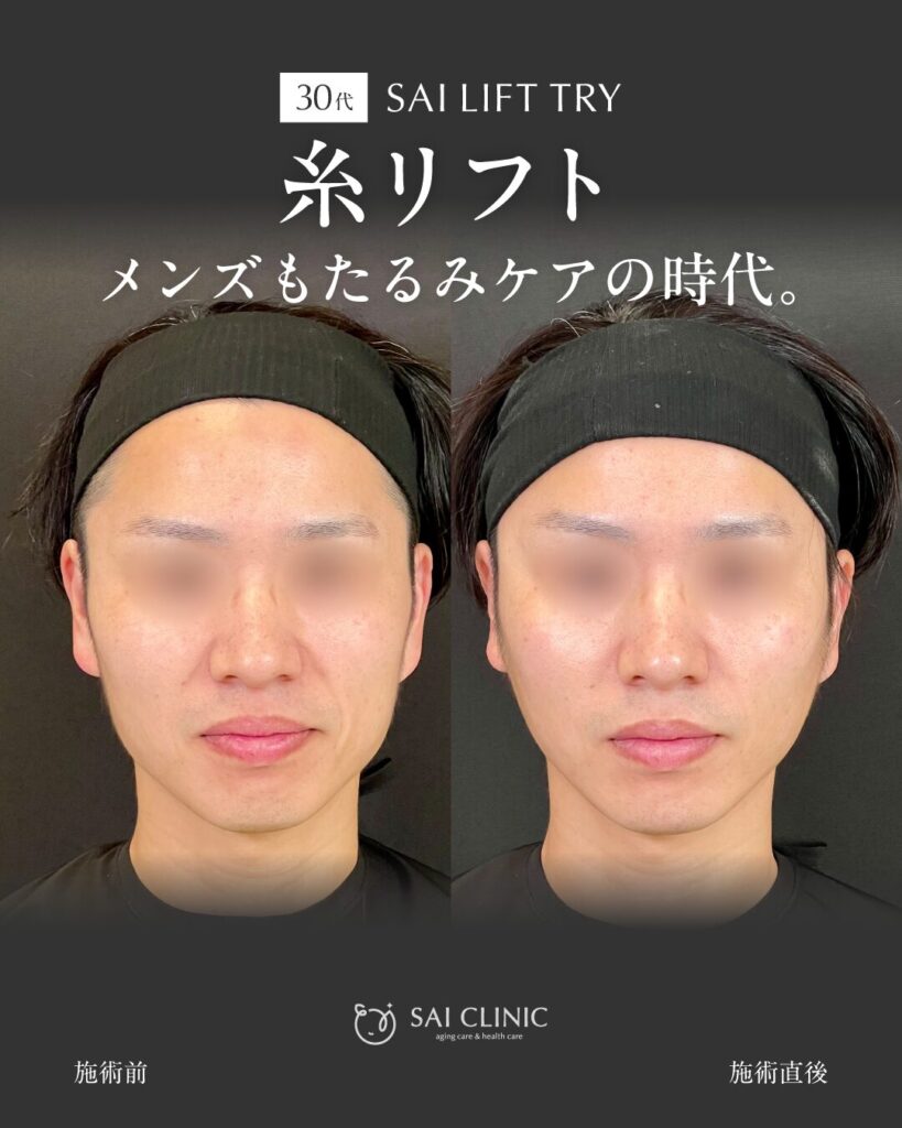 【30代男性】糸リフトでほうれい線・たるみスッキリ