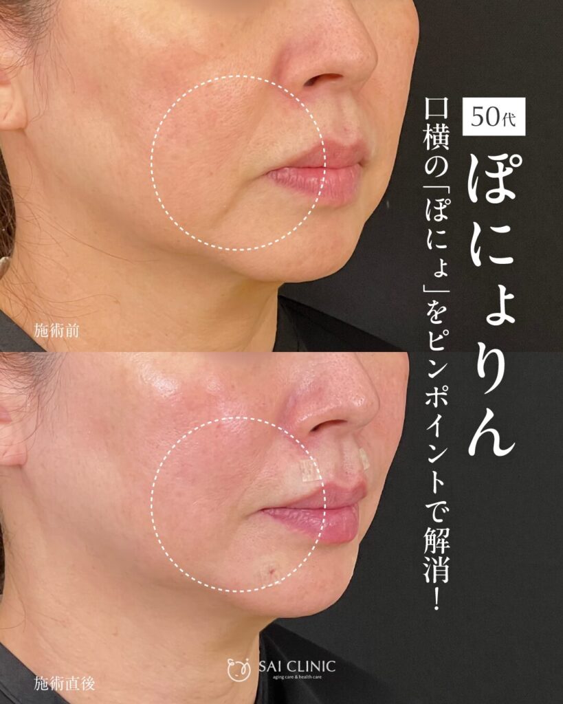 50代モニター様 ぽにょりん8本