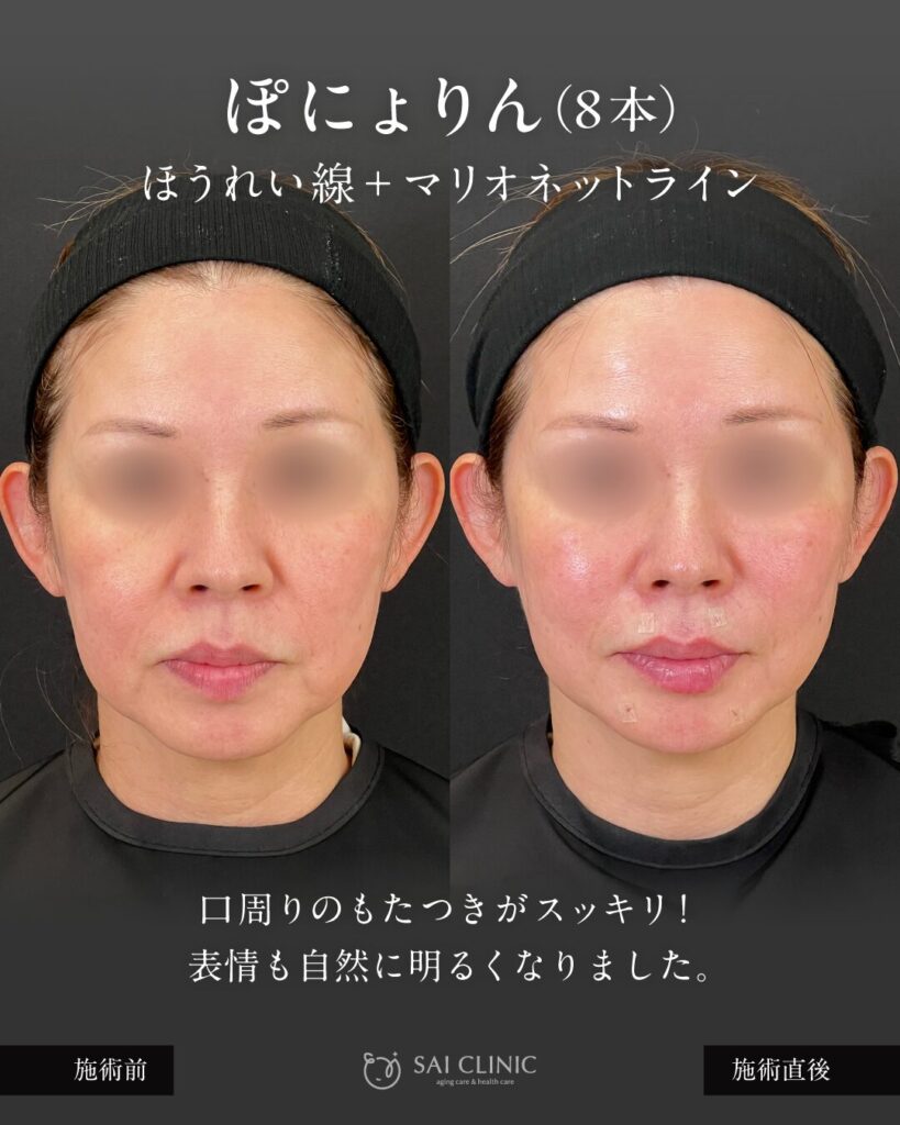 50代モニター様 ぽにょりん8本 施術直後