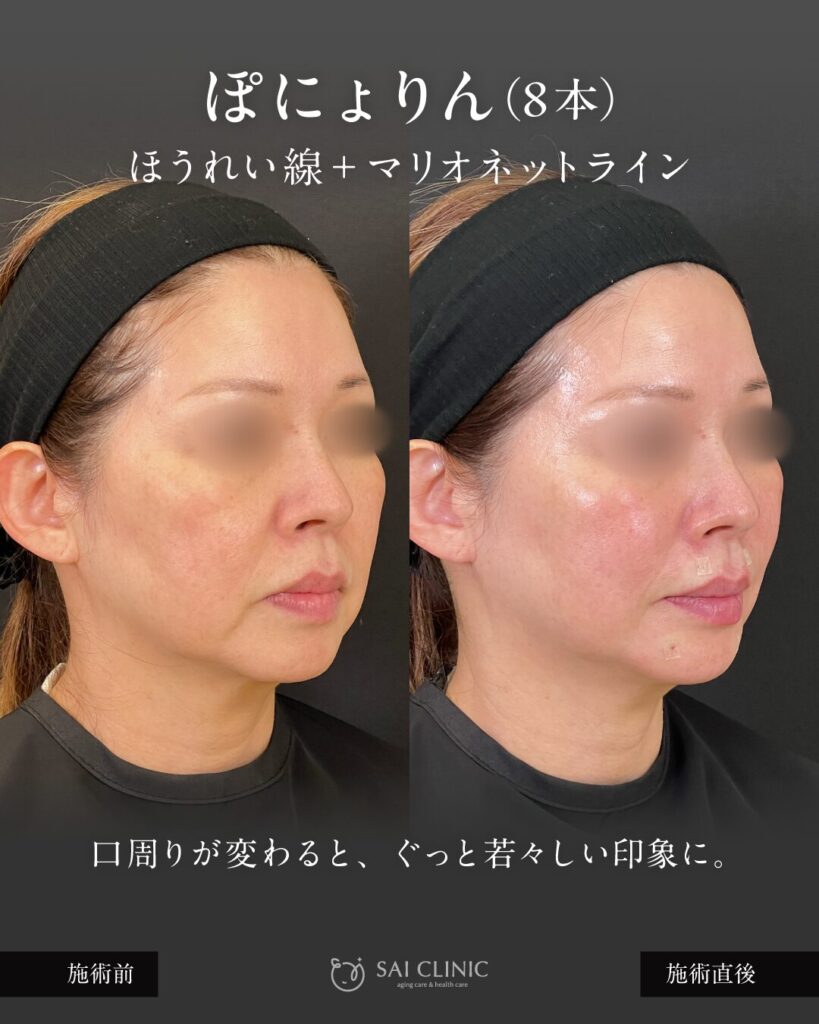 50代モニター様 ぽにょりん8本 施術直後