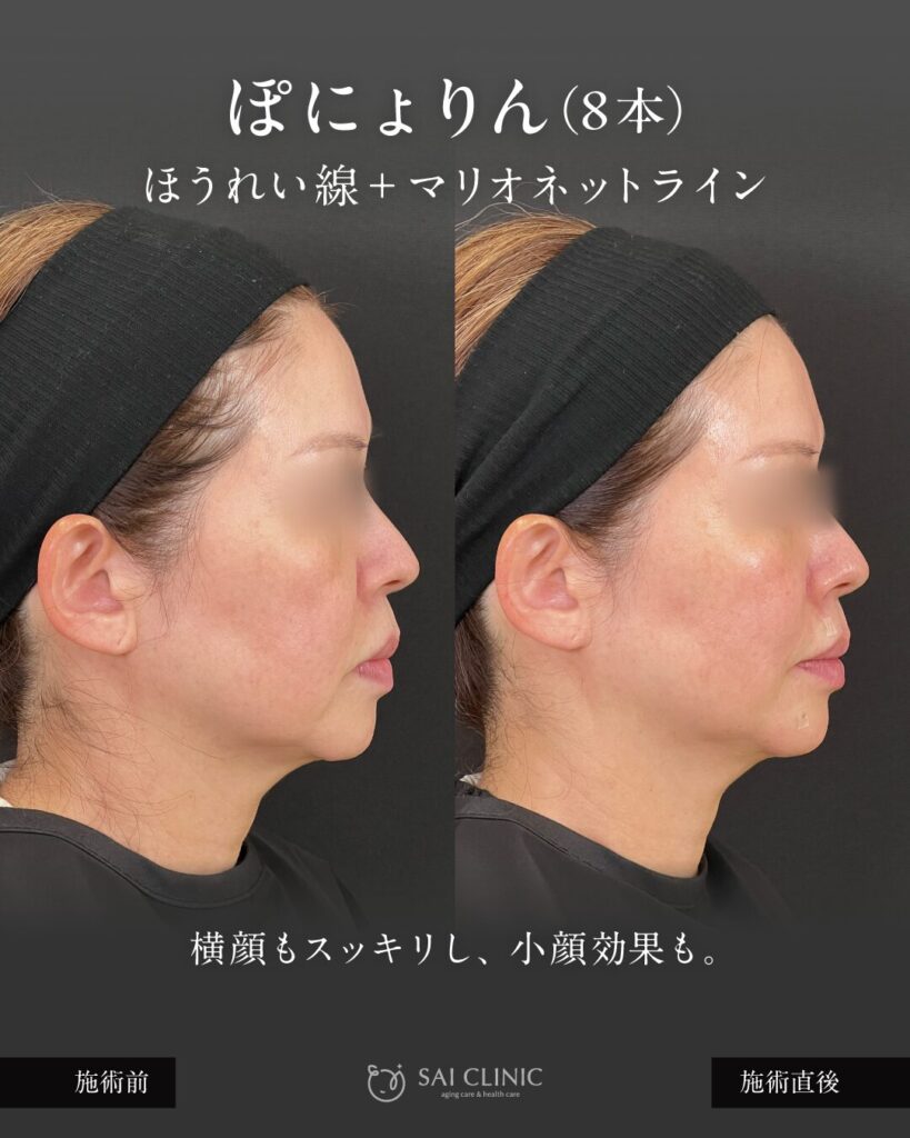 50代モニター様 ぽにょりん8本 施術直後