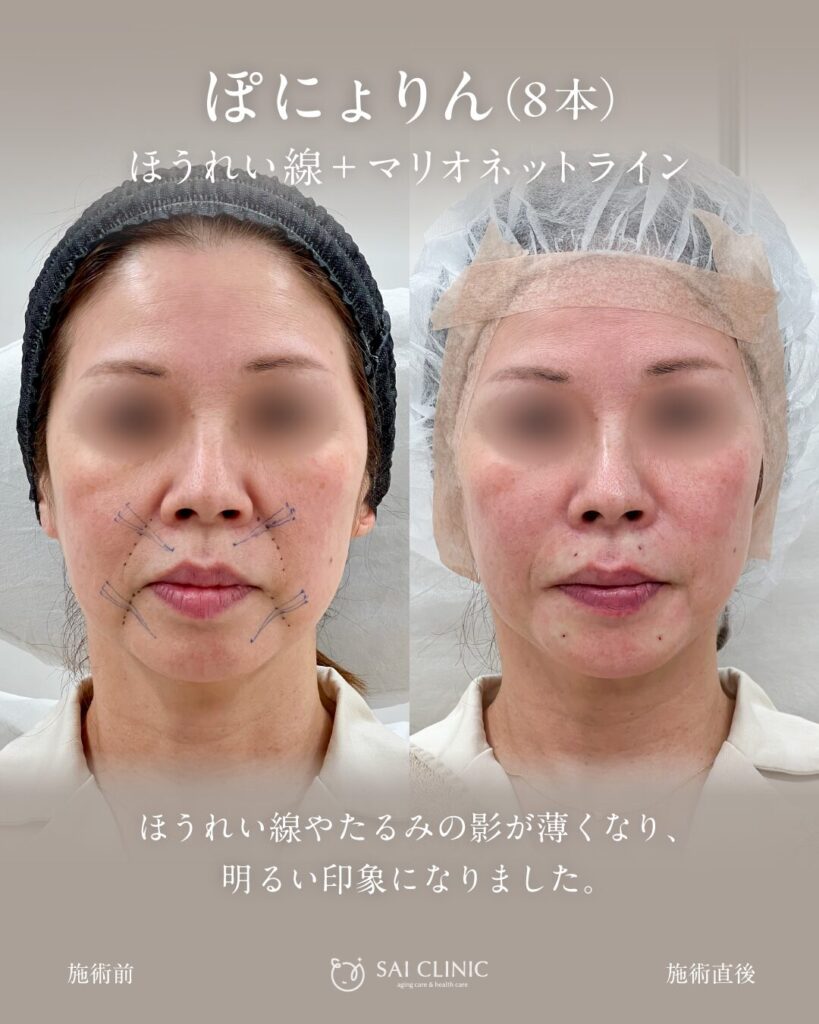 50代モニター様 ぽにょりん8本 施術直後